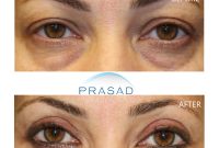 Laser Treatment for Dark Circles Under Eyes | Dr. Prasad Blog How To Write A Resume That Stands Out